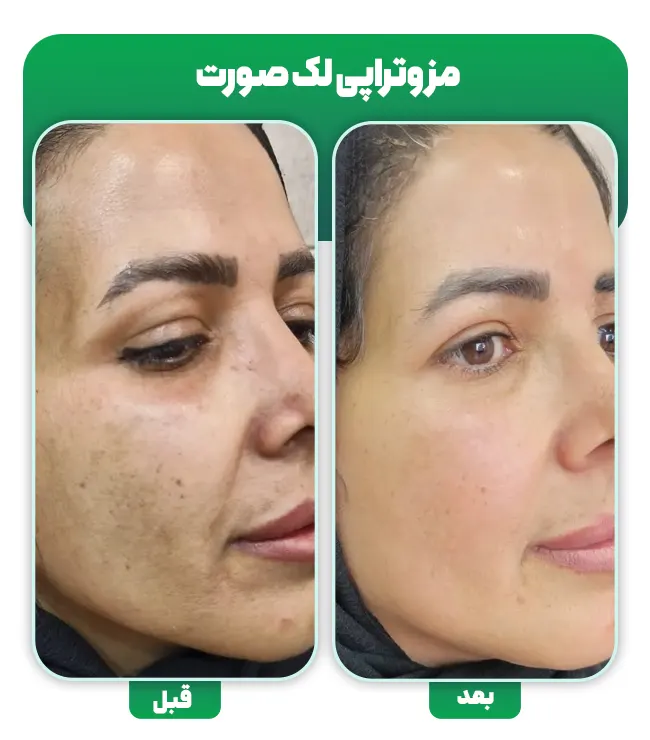 مزوتراپی جوانساز صورت