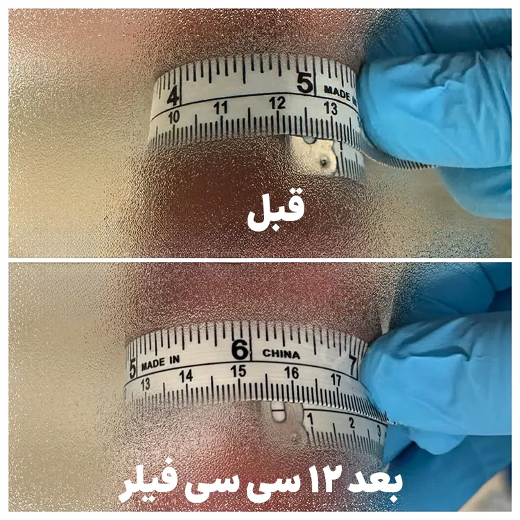 قبل و بعد تزریق فیلر آلت تناسلی