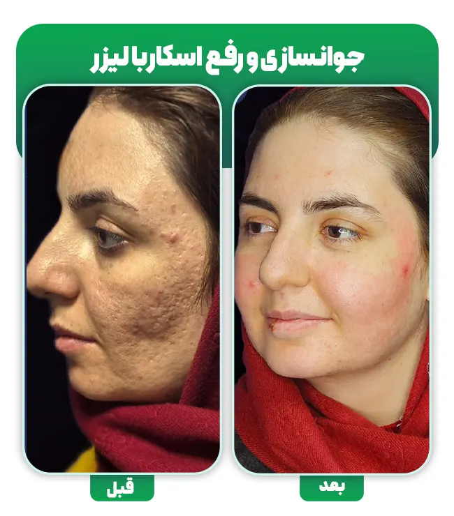 لیزر اسکار جای جوش