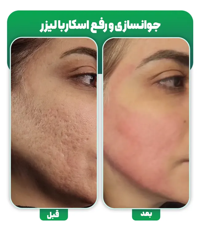 لیزر اسکار جای جوش