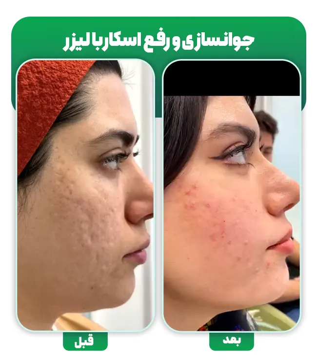 لیزر اسکار