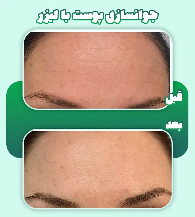 جوانسازی پوست با لیزر