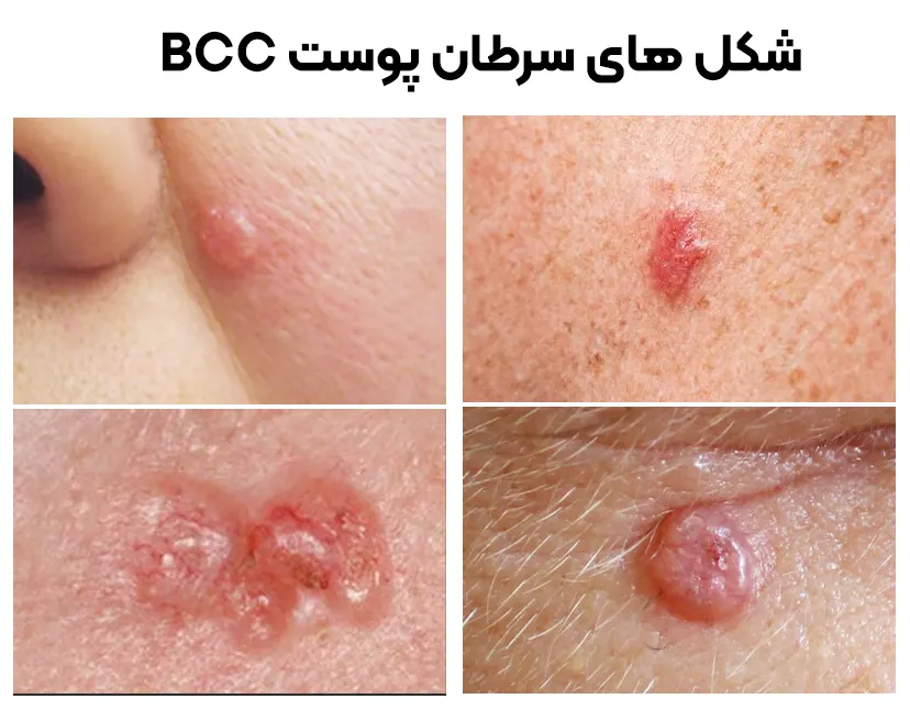سرطان سلول‌های بازال BCC