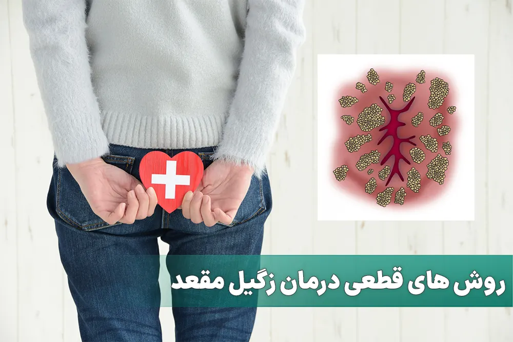 روش های قطعی درمان زگیل مقعد