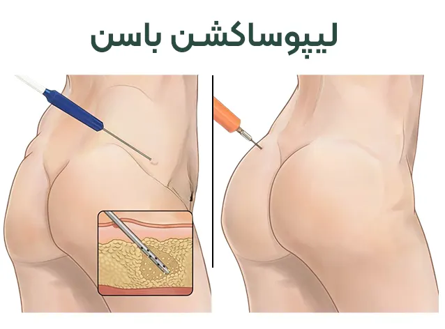 لیپوساکشن باسن