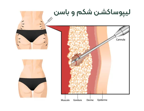 لیپوساکشن باسن