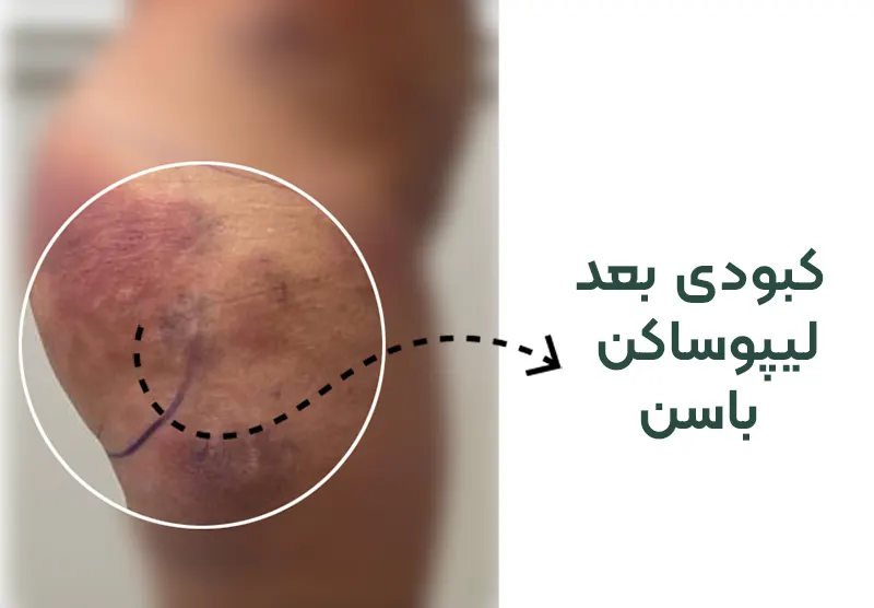خطرات و عوارض لیپوساکشن باسن