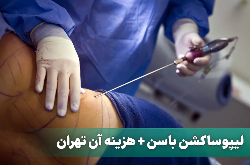 لیپوساکشن باسن