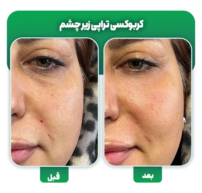 کربوکسی تراپی زیر چشم