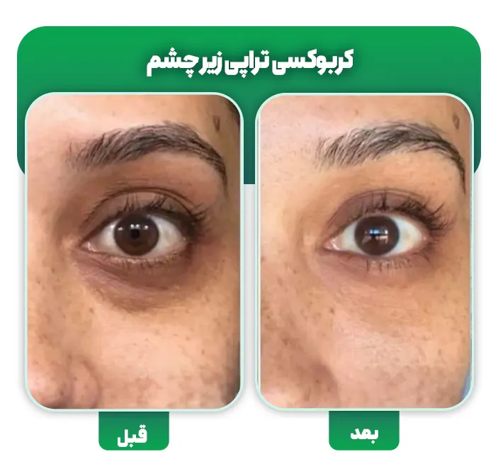 کربوکسی تراپی زیر چشم