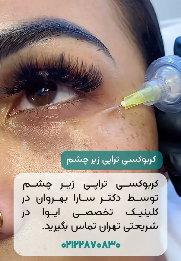 کربوکسی تراپی زیر چشم