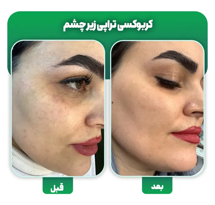 کربوکسی تراپی زیر چشم