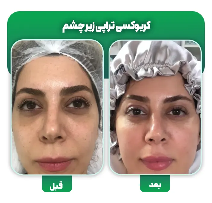 کربوکسی تراپی زیر چشم