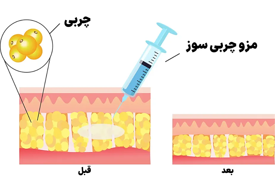 مزوتراپی چربی سوز