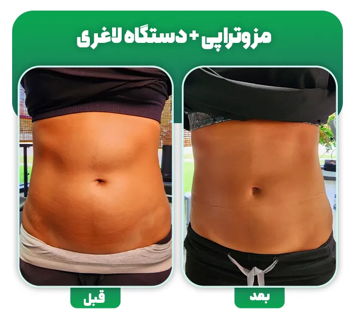 مزوتراپی چربی سوز