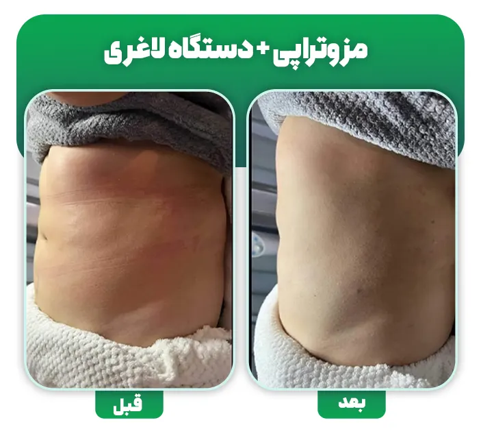 مزوتراپی چربی سوز