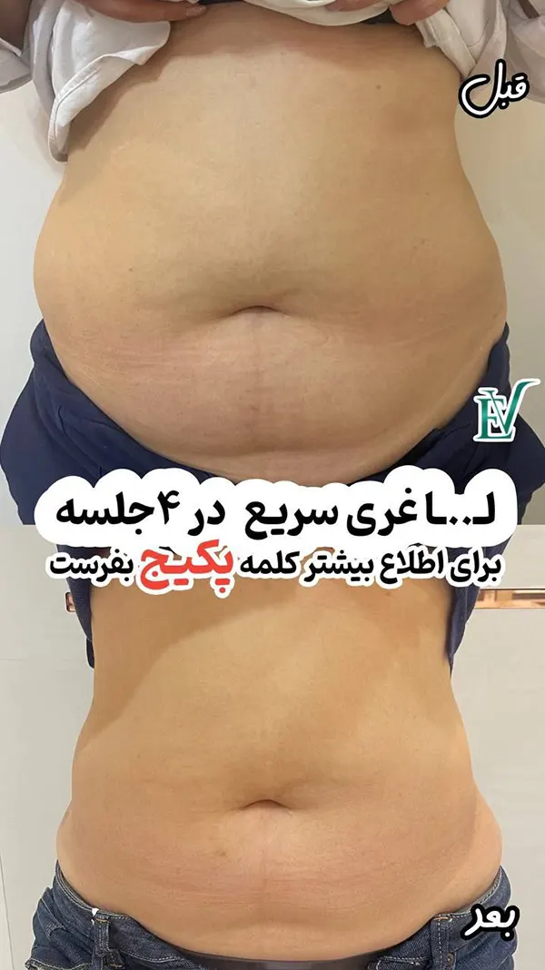 لاغری مزوتراپی