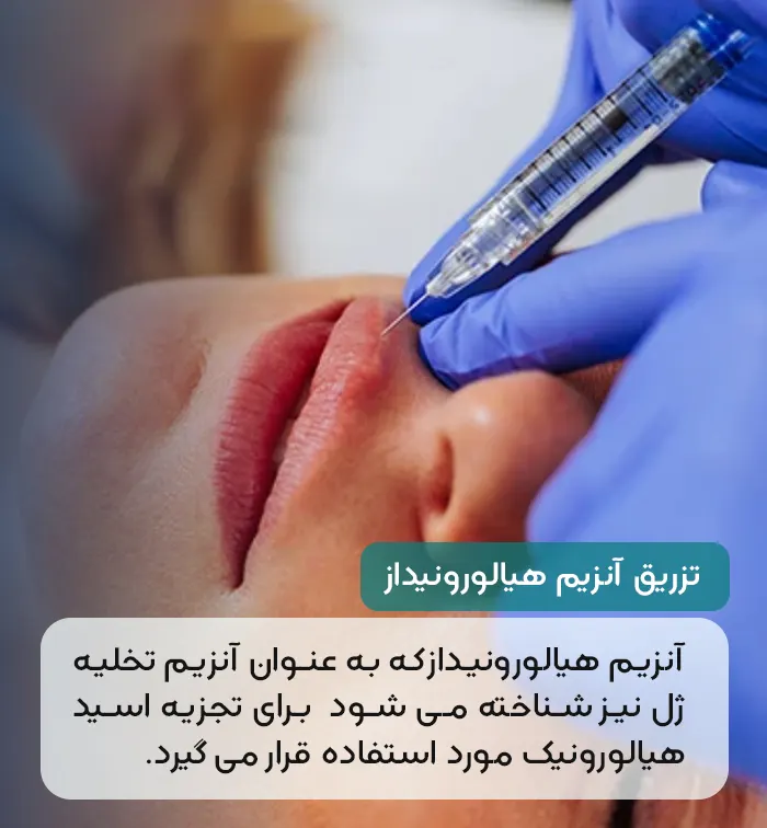 تزریق آنزیم هیالورونیداز