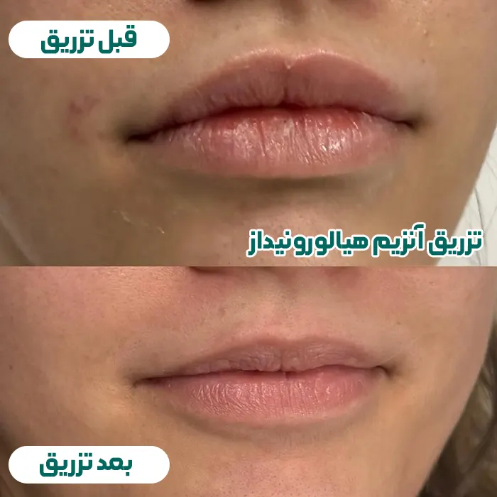 تزریق آنزیم هیالورونیداز به لب