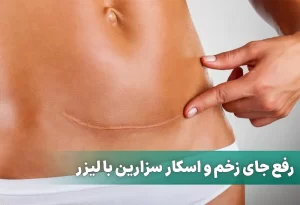 رفع جای زخم و اسکار سزارین با لیزر