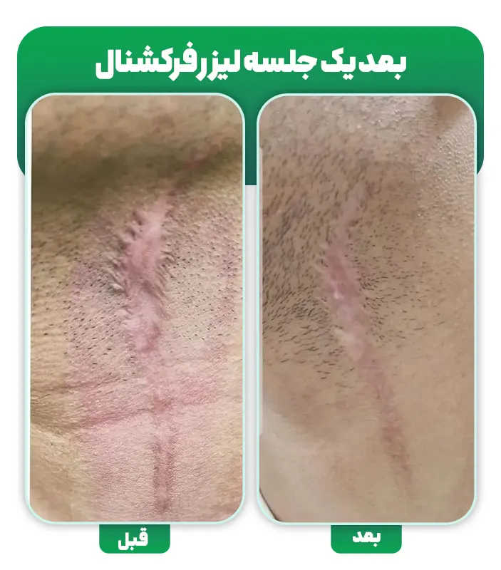 لیزر جای زخم