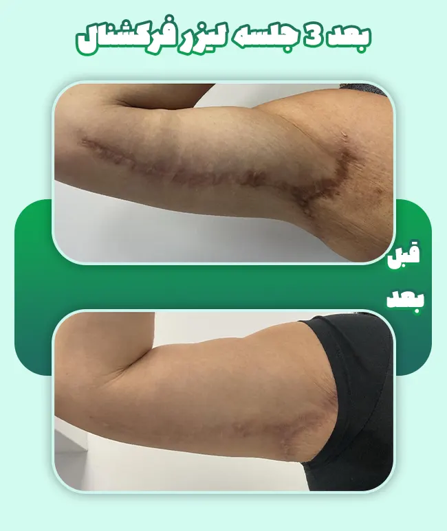 لیزر جای زخم
