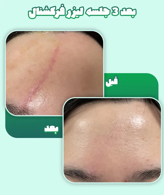 لیزر جای زخم