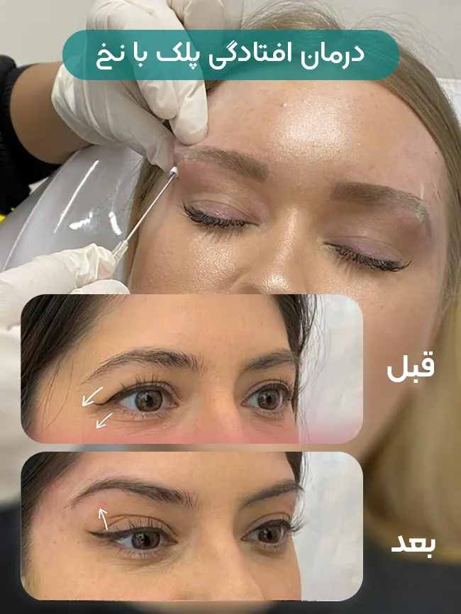 لیفت پلک با نخ