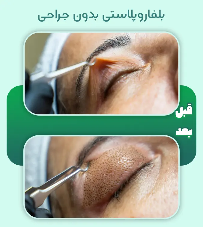 بلفاروپلاستی بدون جراحی