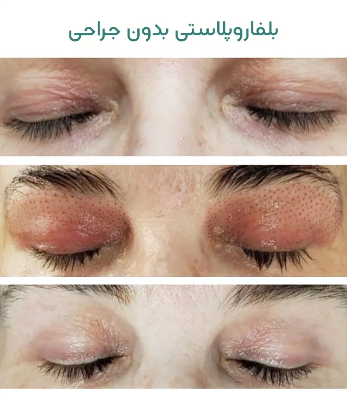 بلفاروپلاستی بدون جراحی