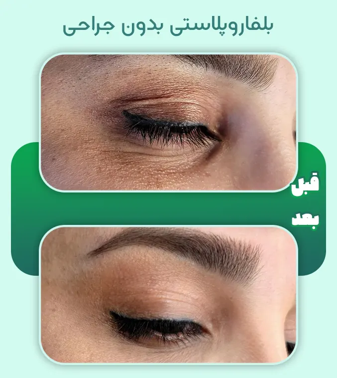 بلفاروپلاستی بدون جراحی