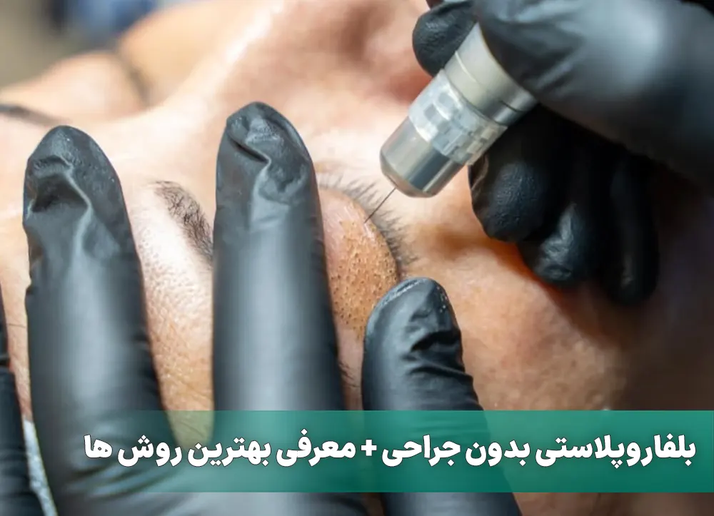 بلفاروپلاستی بدون جراحی