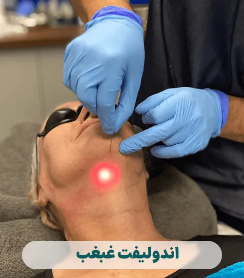 اندولیفت غبغب