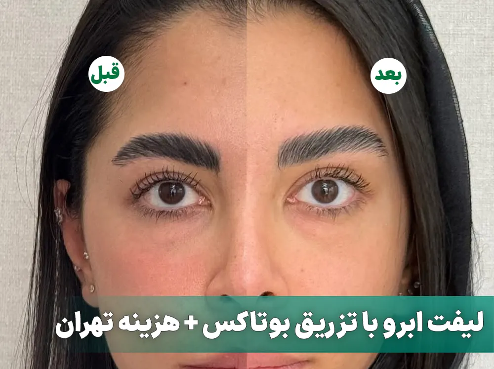 لیفت ابرو با تزریق بوتاکس