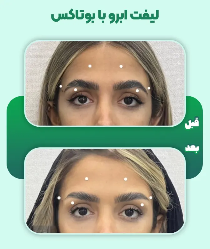 لیفت ابرو با تزریق بوتاکس