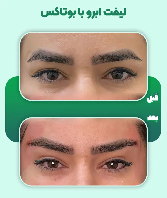 لیفت ابرو با تزریق بوتاکس