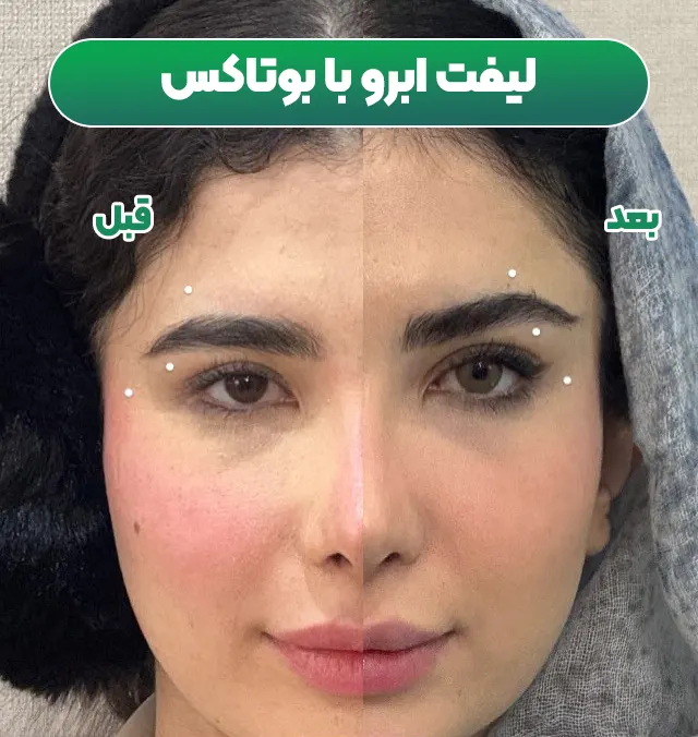 لیفت ابرو با تزریق بوتاکس