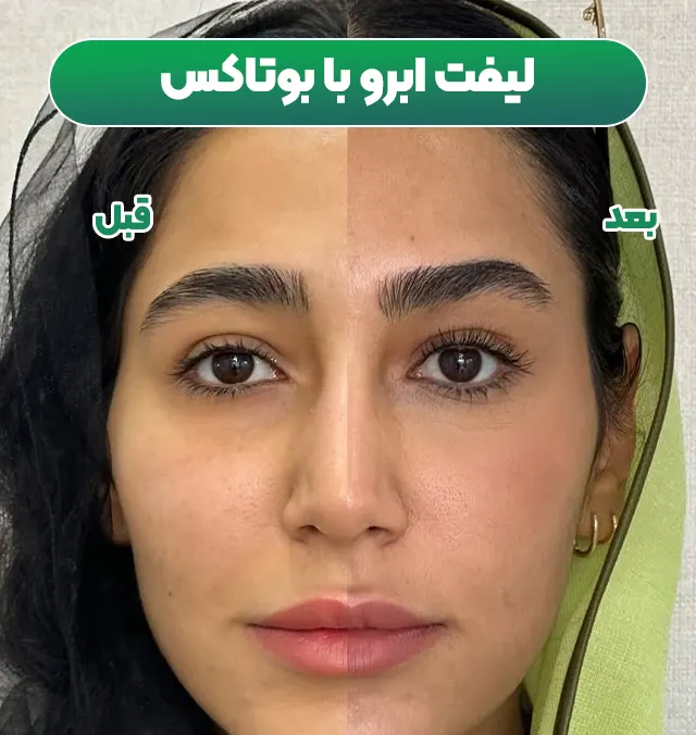 لیفت ابرو با تزریق بوتاکس