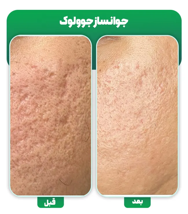 قبل و بعد جوانساز جوولوک