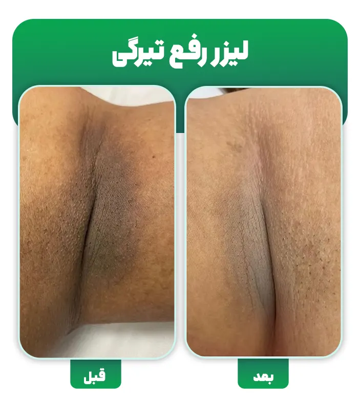لیزر رفع تیرگی
