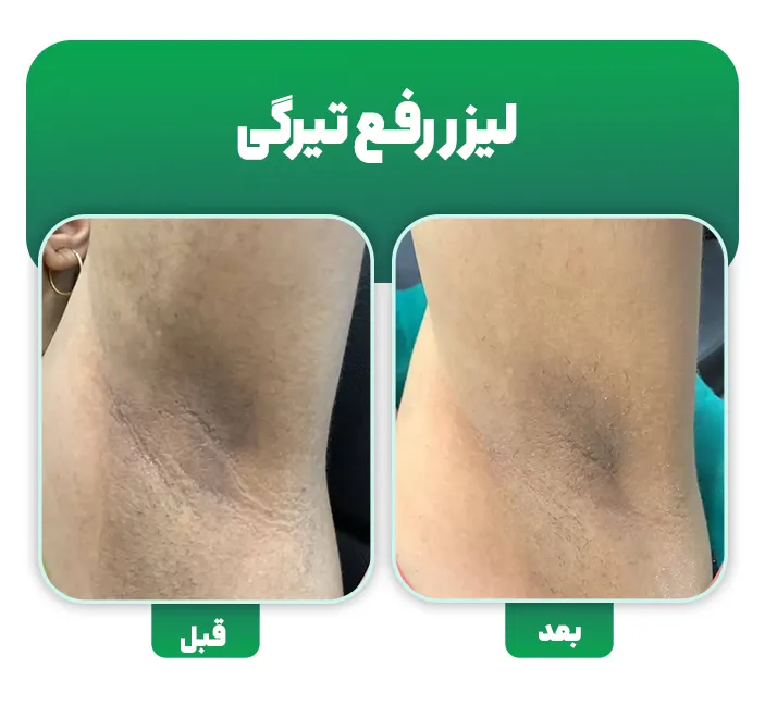 لیزر رفع تیرگی