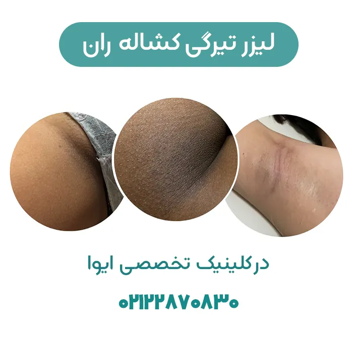 لیزر تیرگی کشاله ران