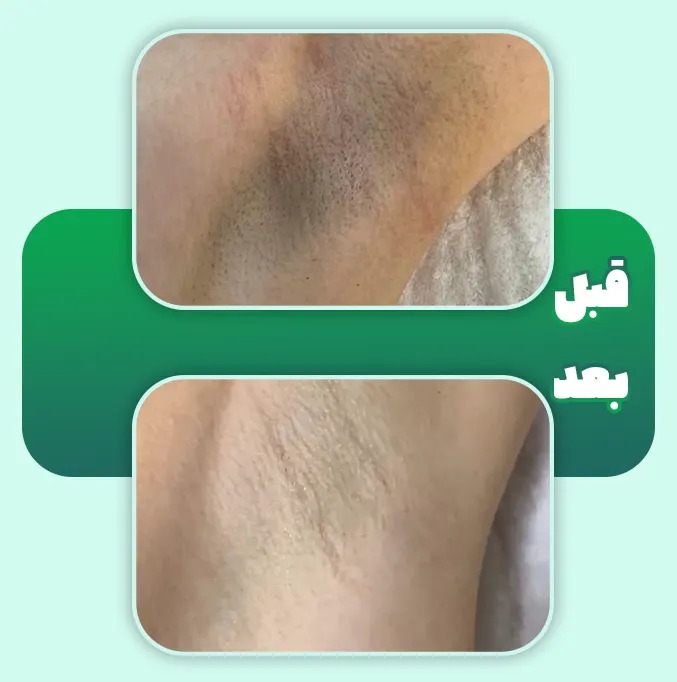 لیزر رفع تیرگی