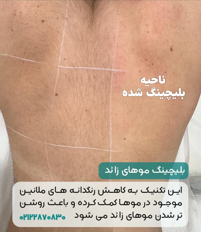 بلیچینگ موهای زائد