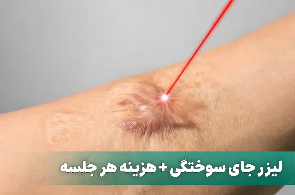 درمان جای سوختگی با لیزر