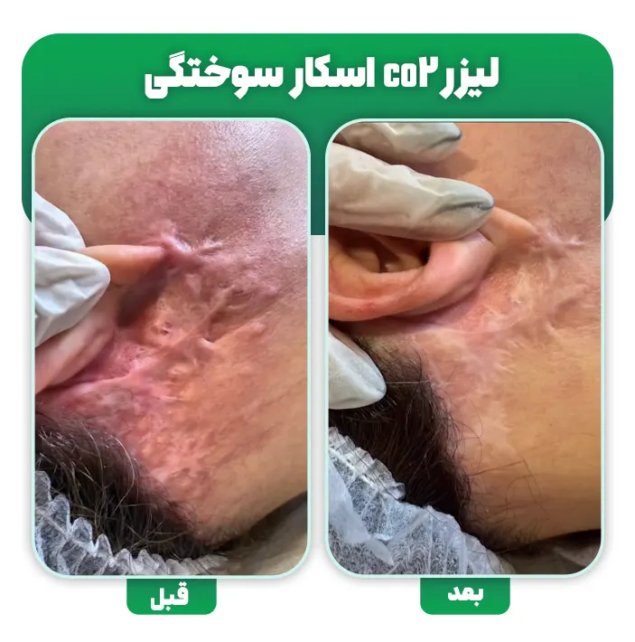 لیزر جای سوختگی