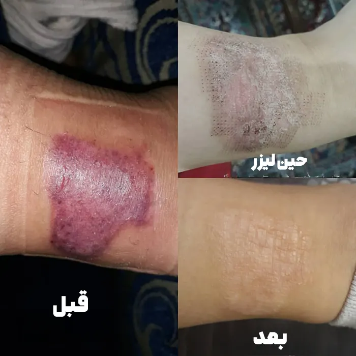 لیزر جای سوختگی