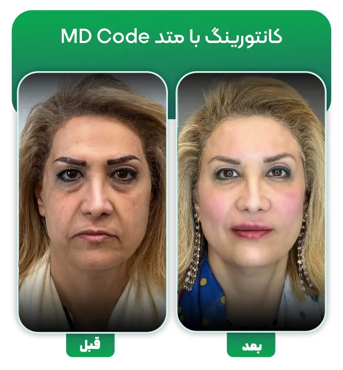 تزریق فیلر با متد MD Code