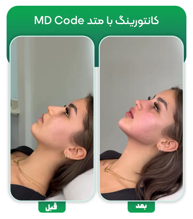 تزریق فیلر با متد MD Code
