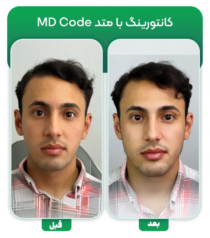 تزریق فیلر با متد MD Code